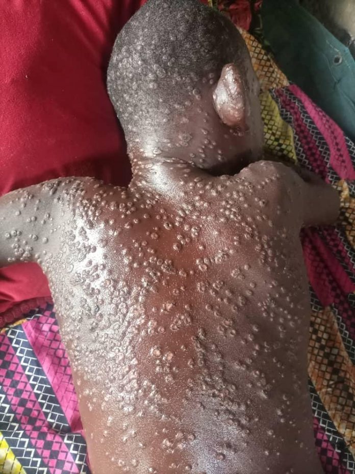 Le virus de Mpox fait surface au Cameroun, déjà deux cas signalé