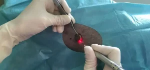 Chirurgie mini-invasive : la nouvelle technique révolutionnaire