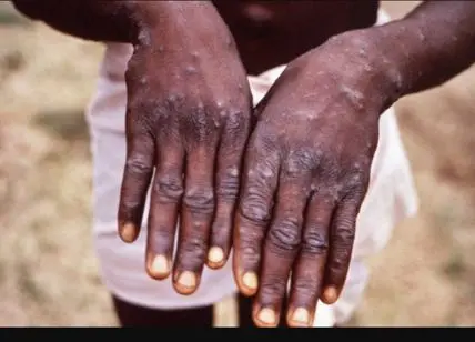 Mpox: l’agence de santé de l’Union africaine déclare « une urgence de santé publique »