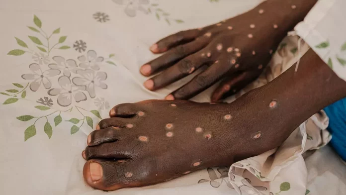 Mpox: les gouttelettes, une voie de transmission mineure selon l’OMS
