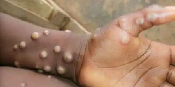 Mpox en Afrique: 866 décès depuis le début de l’année, selon l’Africa CDC