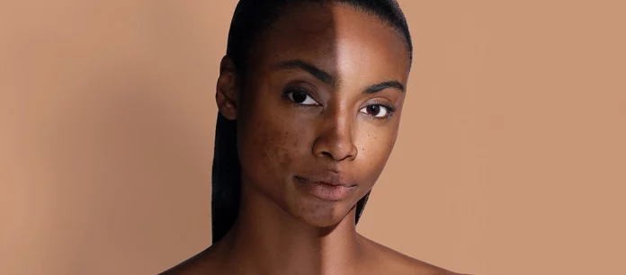 La technologie laser : une solution efficace pour la réduction des rides et des taches