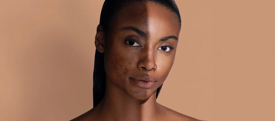 réduction des rides