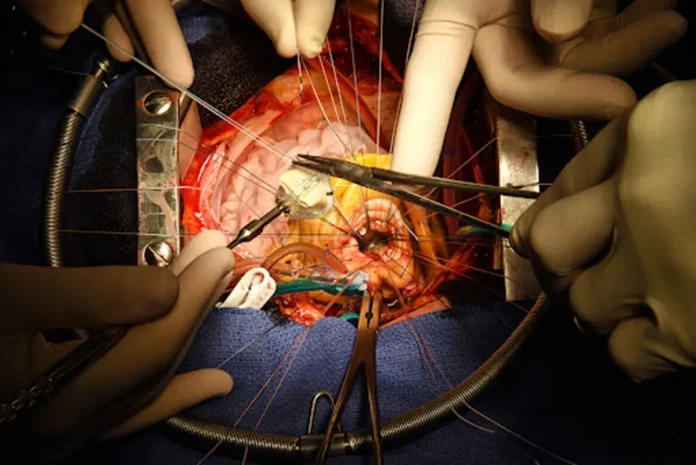 Hôpital Général de Yaoundé : Une chirurgie cardiaque en vue