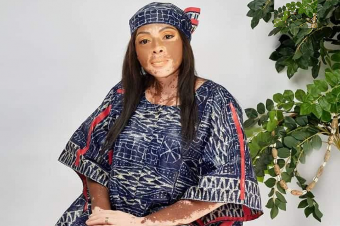 Stetchie : « Le vitiligo n’est pas une fatalité !»