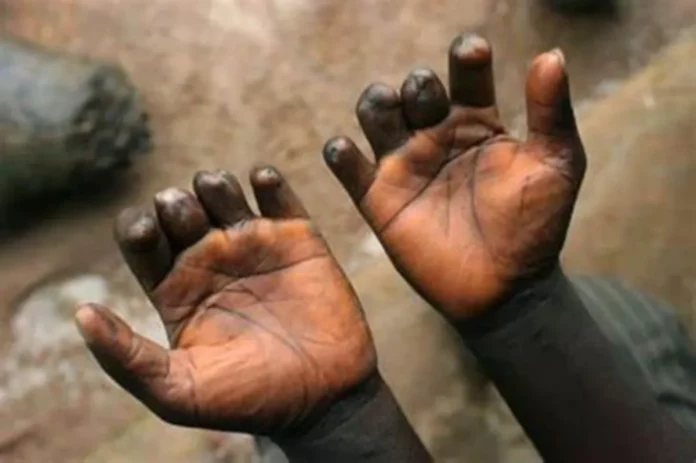 Maladies tropicales négligées : Lèpre, Ulcère de Buruli, Gale…