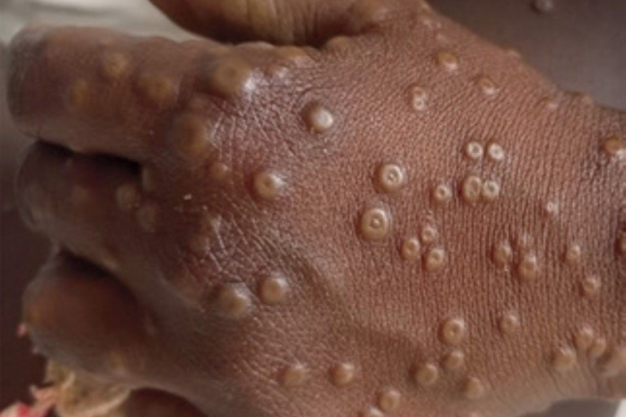 Variole du singe : cinq cas confirmés au Cameroun