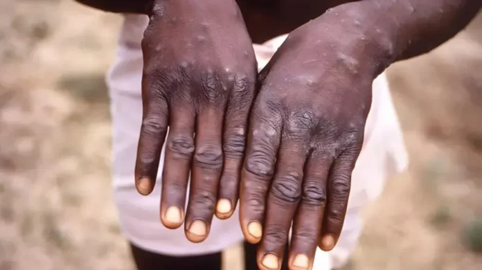 La Mpox à Douala: L’Hôpital de district de Japoma monte la garde