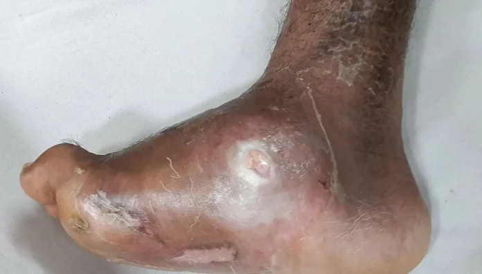 Diabète : Plaies et infections se soignent