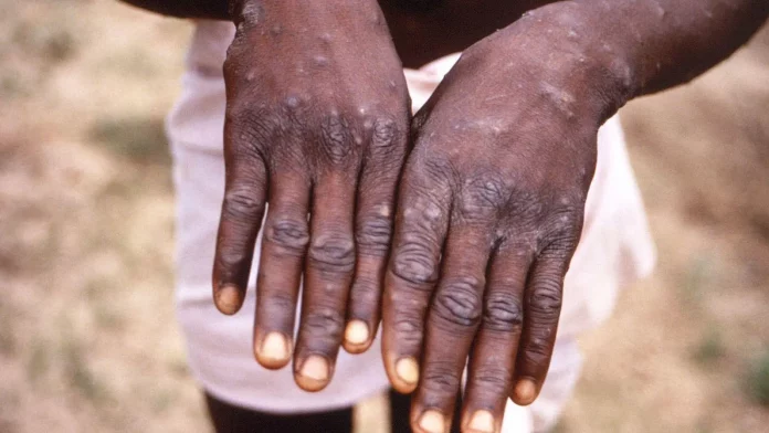 Cameroun : Un seul cas actif de Mpox dans le Littoral