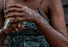 Mpox : Le Sud dans l’épidémie épidémie de Mpox Sud
