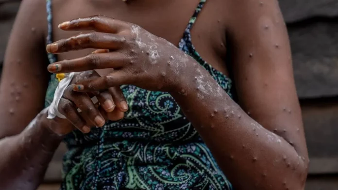 Mpox : Le Sud dans l’épidémie